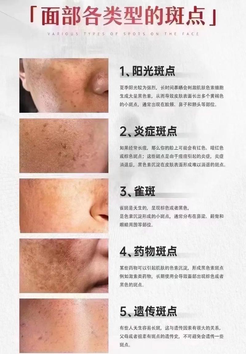 皮肤有黑色素沉淀怎么办