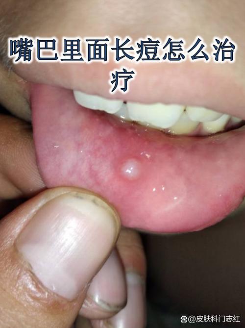 口腔内有小疙瘩是怎么回事