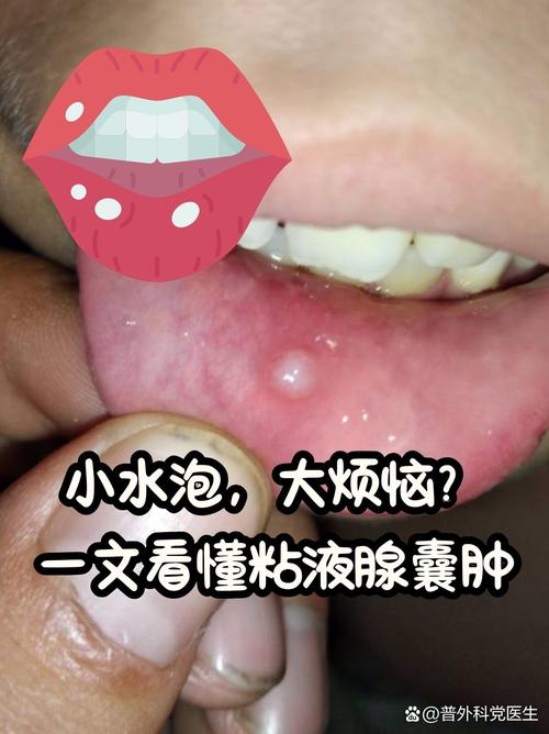 口腔内有小疙瘩是怎么回事