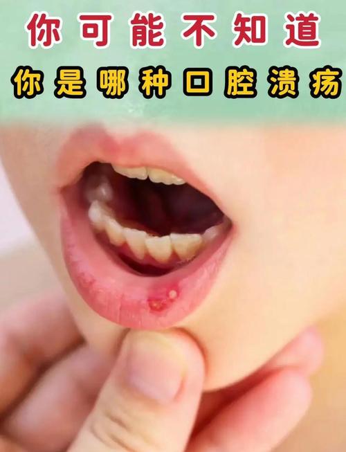口腔溃疡反复发作,到底为啥?