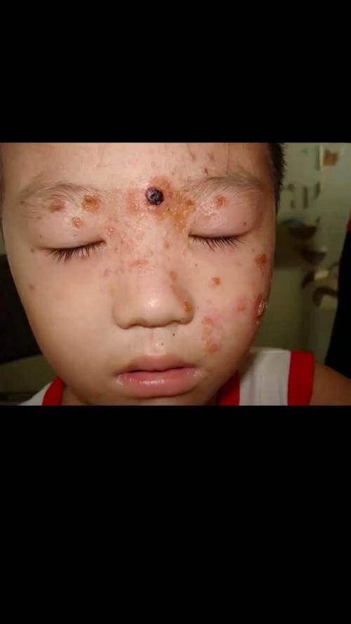 金葡菌烫伤样皮肤综合征是何病?