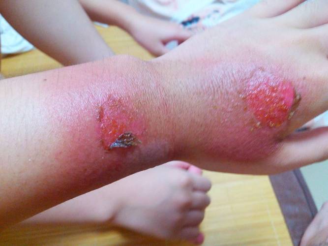 金葡菌烫伤样皮肤综合征是何病?