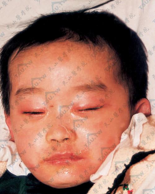 金葡菌烫伤样皮肤综合征是何病?