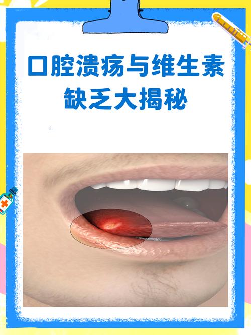 口腔溃疡是缺少什么维生素