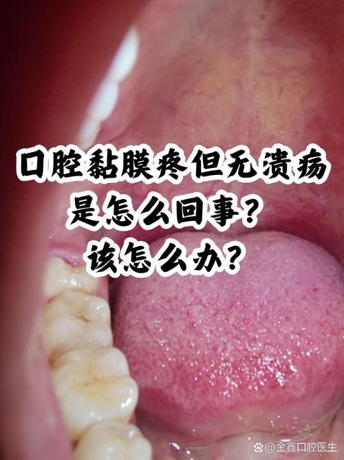 口腔上颚粘膜烂了怎么办?