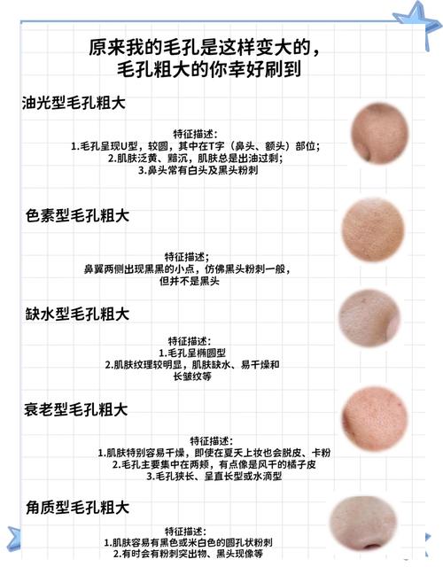 毛孔粗大皮肤油腻怎么办