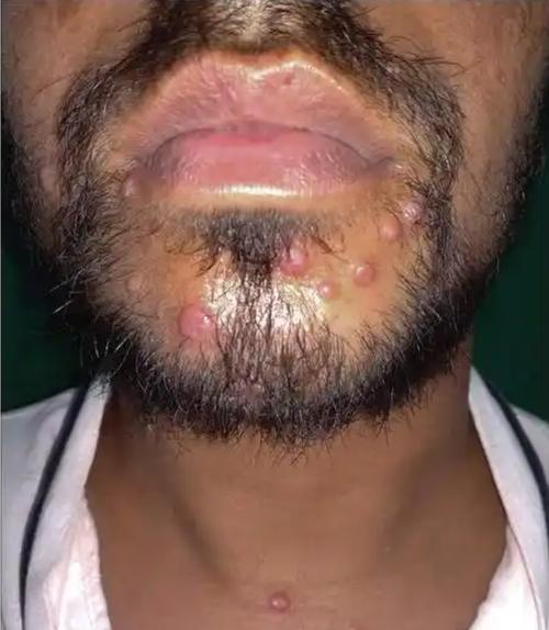 艾滋病初期皮肤症状图片有哪些特征?