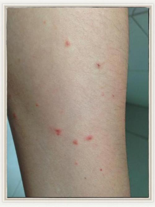 艾滋病初期皮肤症状图片有哪些特征?