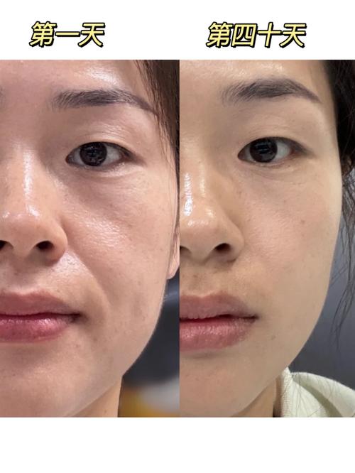 皮肤松弛下垂,如何有效紧致提升?