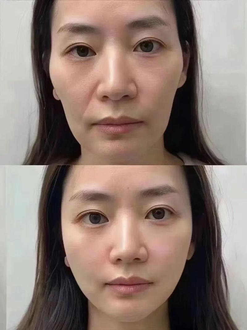 皮肤松弛下垂,如何有效紧致提升?