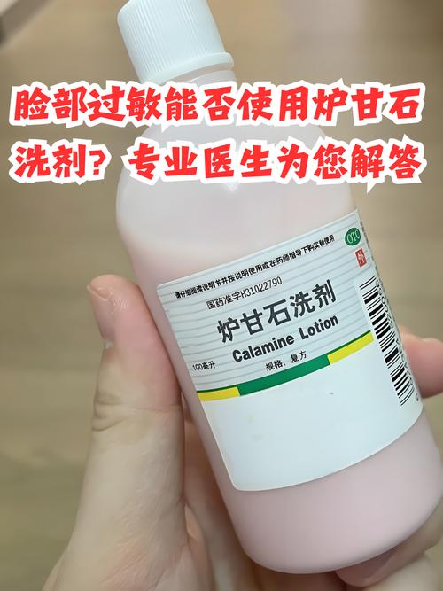 皮肤过敏能用炉甘石吗?