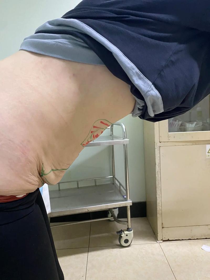 减肥后皮肤松弛怎么紧致?