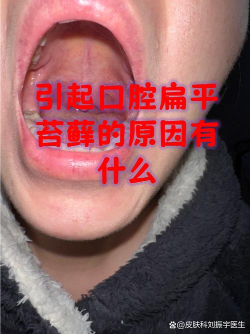 口腔扁平苔藓几年会致命吗?