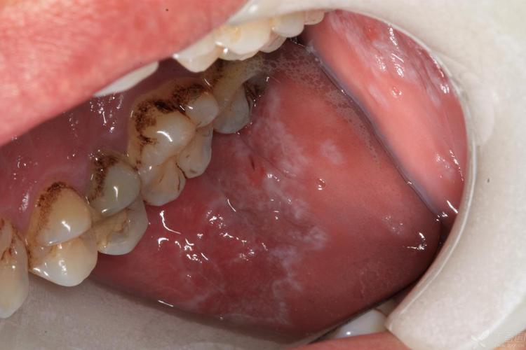 口腔扁平苔藓几年会致命吗?