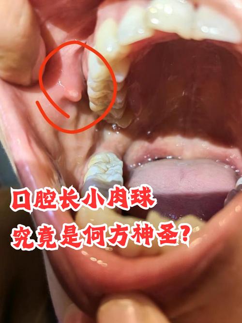 口腔内长肉疙瘩疼是什么原因?