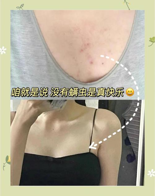 有螨虫的皮肤会发红、瘙痒吗?