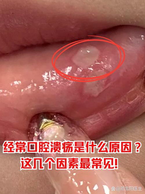 老年人口腔溃疡为何反复发作?