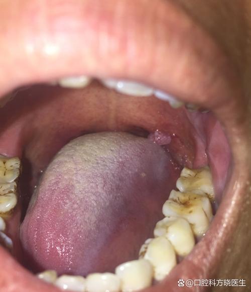 口腔内侧突然鼓包是何原因?
