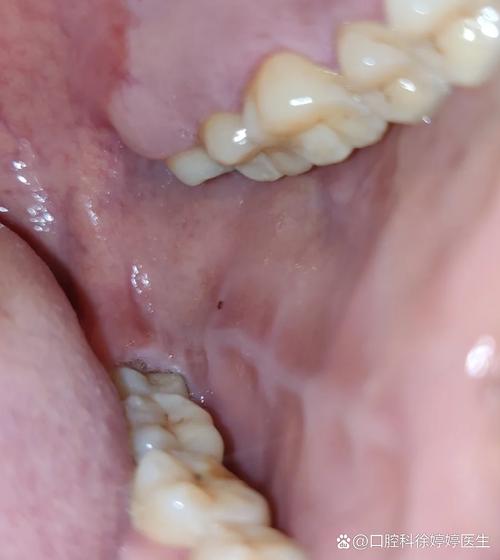 口腔内侧突然鼓包是何原因?