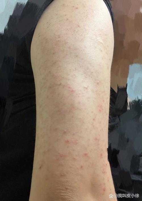 手臂鸡皮肤怎么消除?