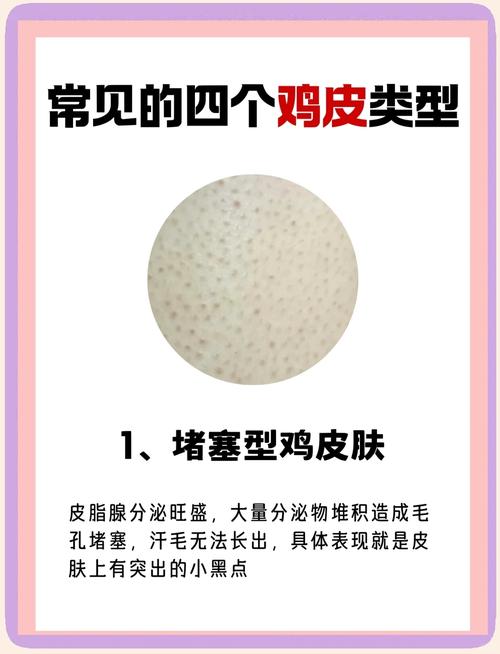 手臂鸡皮肤怎么消除?