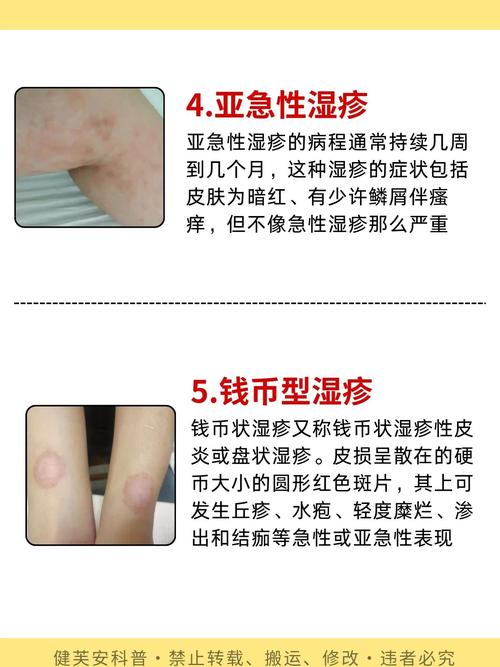 湿疹皮肤干燥开裂,怎么快速修复保湿?