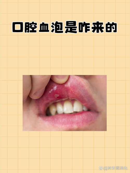 口腔血泡破了会怎样?需立即处理吗?