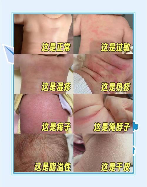 孩子皮肤发黄是何原因?