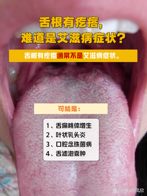 艾滋会通过口腔传播吗?