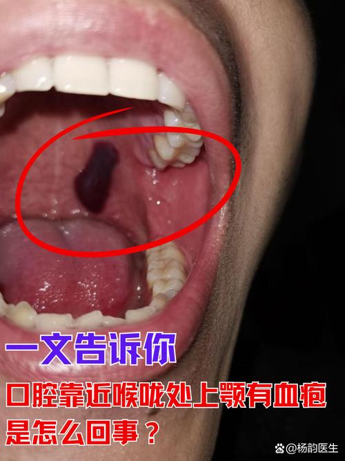 晚上睡觉口腔为何有血?