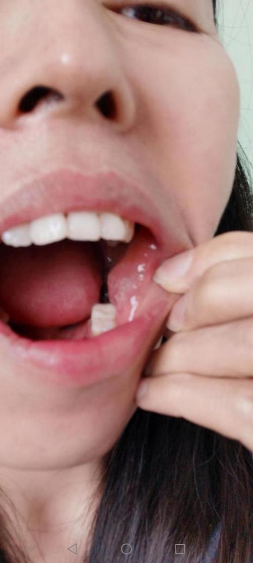 口腔扁平苔藓能吃鸡蛋吗?