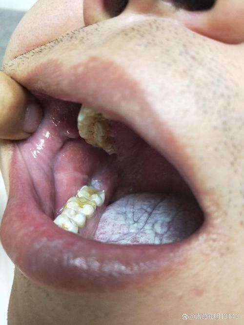 口腔扁平苔藓能吃鸡蛋吗?