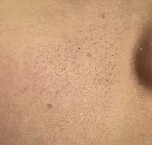 皮肤毛孔粗大有黑头粉刺