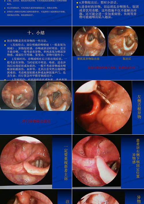 鼻腔口腔连接处异物如何处理?