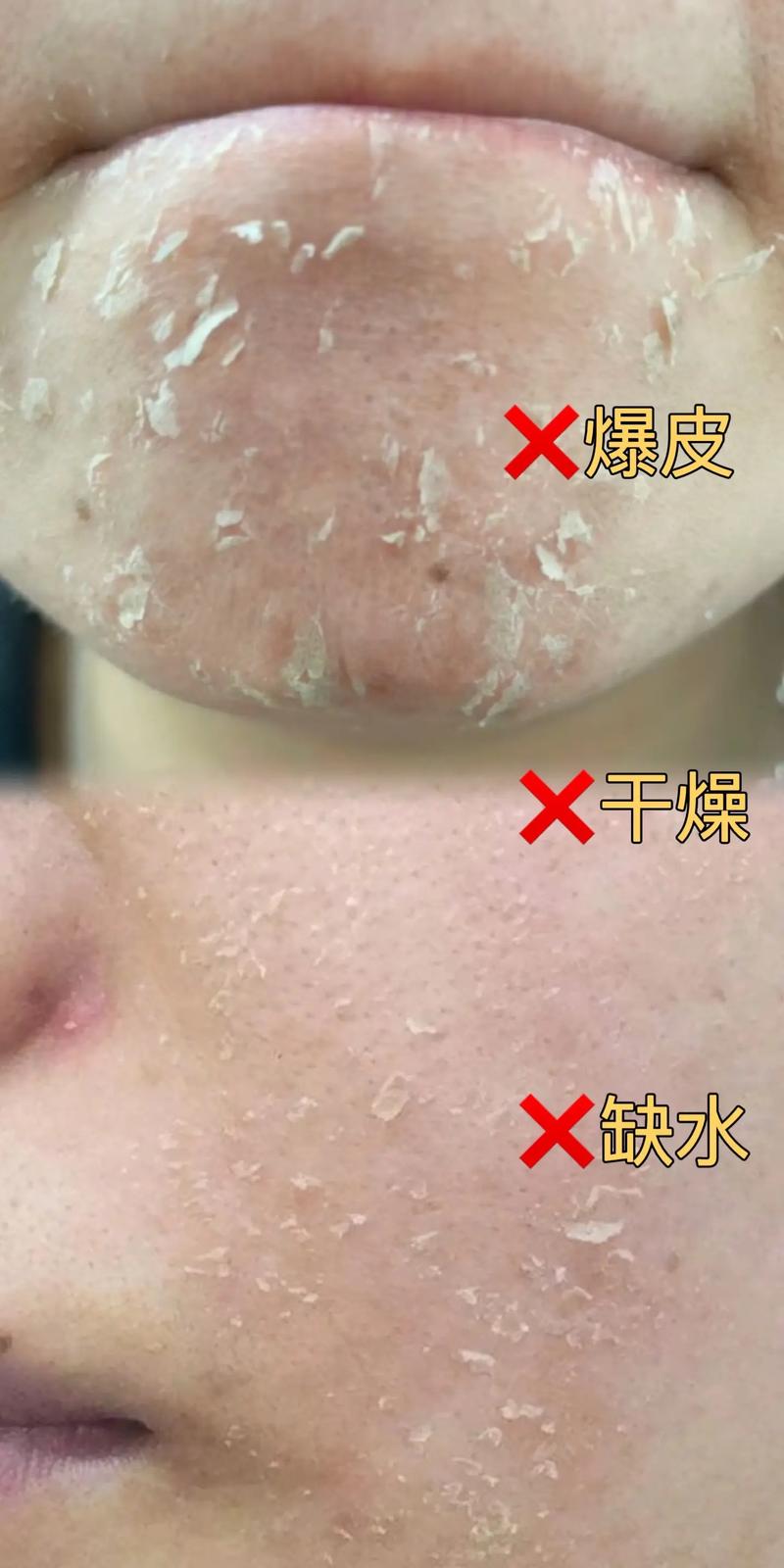 脸上皮肤干燥是缺水还是生病了?