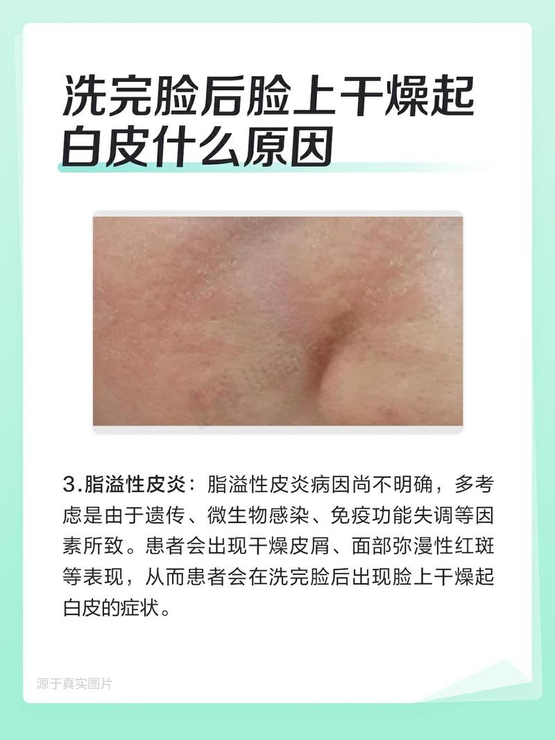 脸上皮肤干燥是缺水还是生病了?