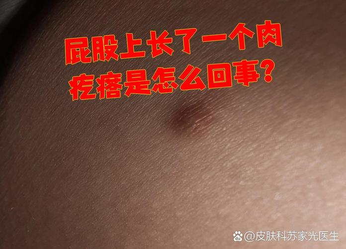 皮肤长肉疙瘩是何原因?