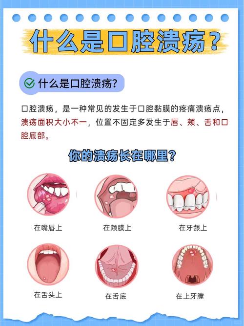 四岁小孩口腔溃疡怎么办?