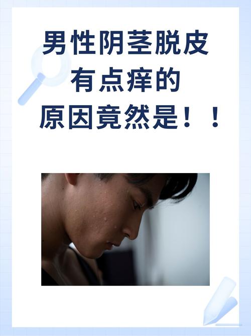 男生皮肤干燥起皮怎么快速解决?