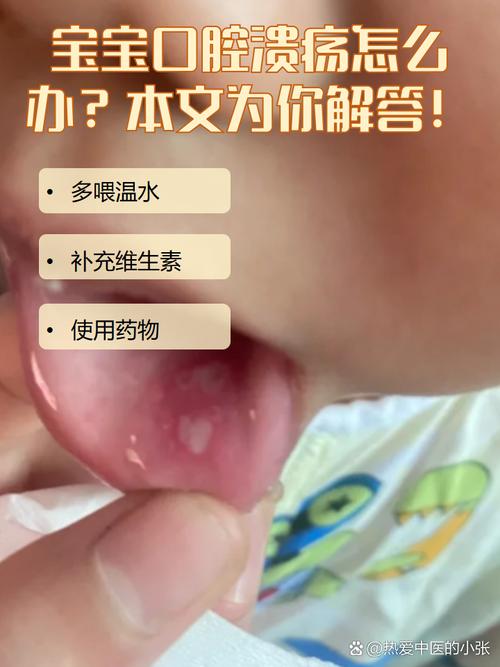 4岁宝宝口腔溃疡怎么办?