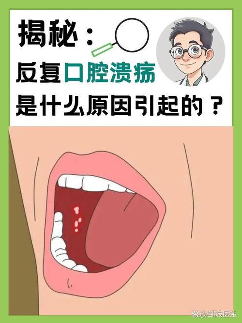 口腔溃疡发烧是关联还是巧合?