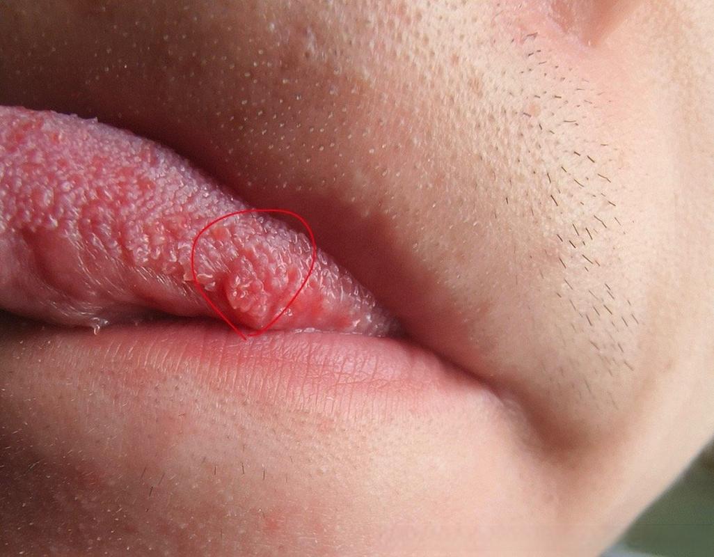 接吻会传染口腔尖锐湿疣吗?