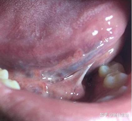 接吻会传染口腔尖锐湿疣吗?