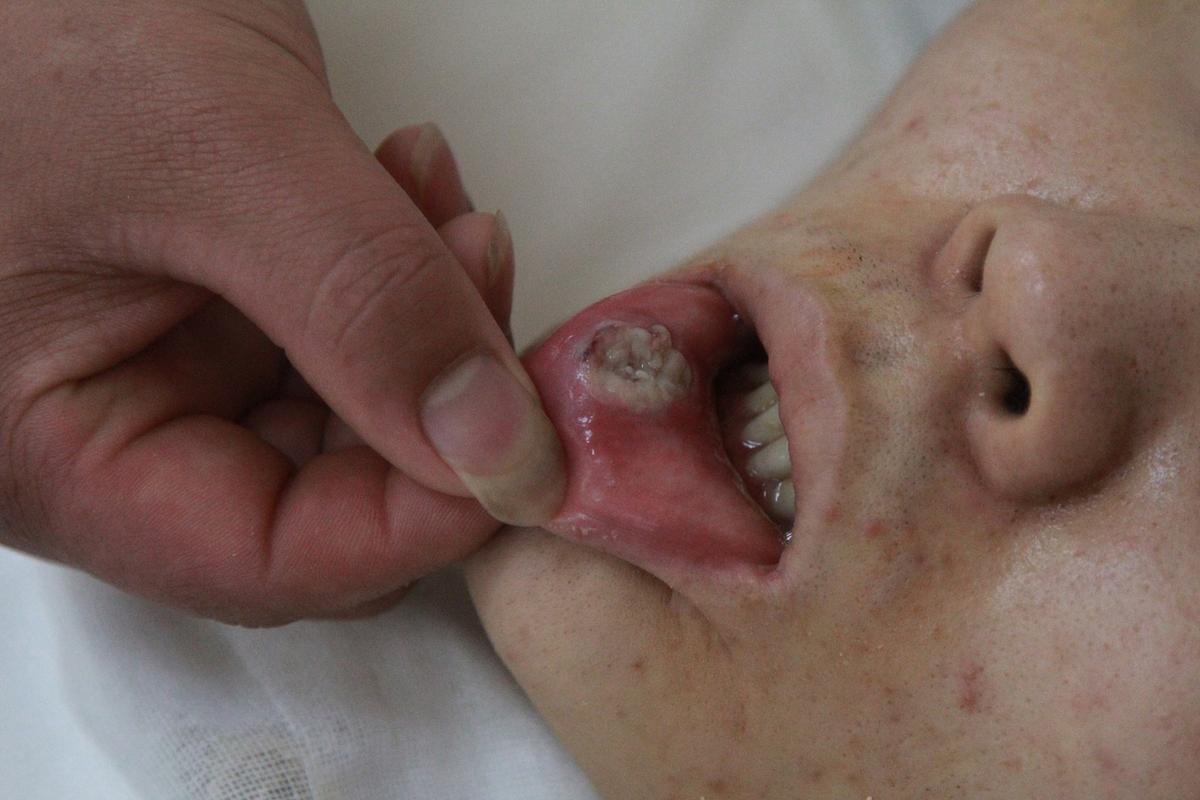 接吻会传染口腔尖锐湿疣吗?