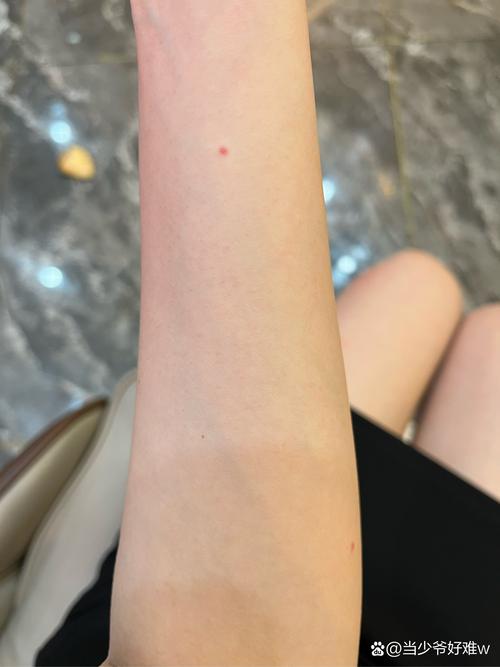 皮肤上起无痛痒小红点是何原因?