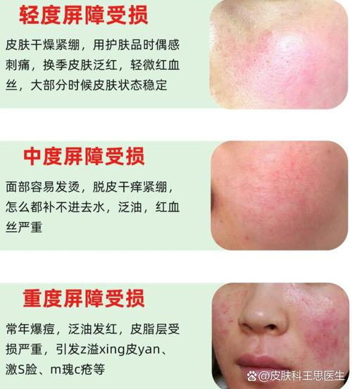 脸部皮肤发红是过敏还是其他问题?