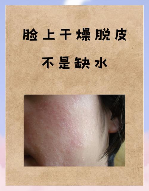 皮肤干燥粗糙怎么快速改善?