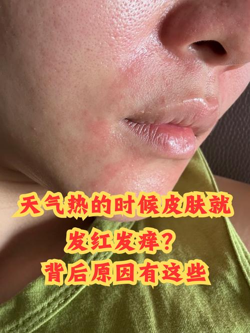 皮肤发热发红是过敏还是炎症?