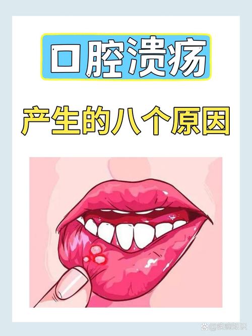 口腔溃疡频发,是身体缺了啥还是生病了?