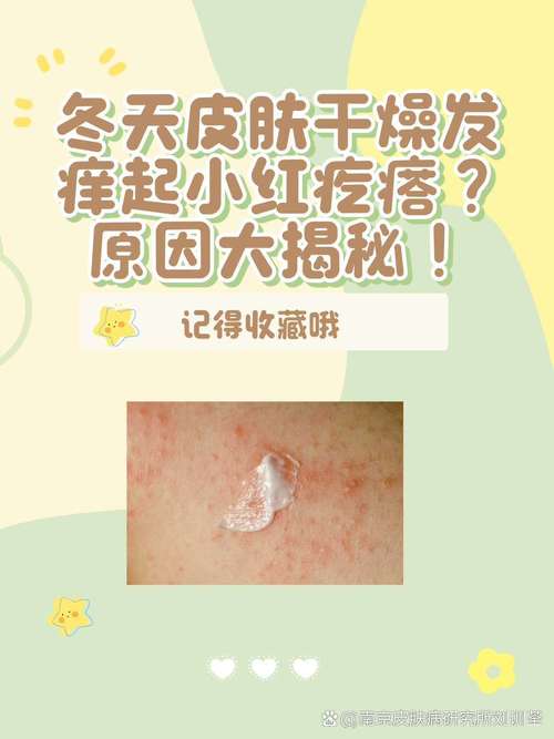 冬天皮肤瘙痒,究竟为何作祟?